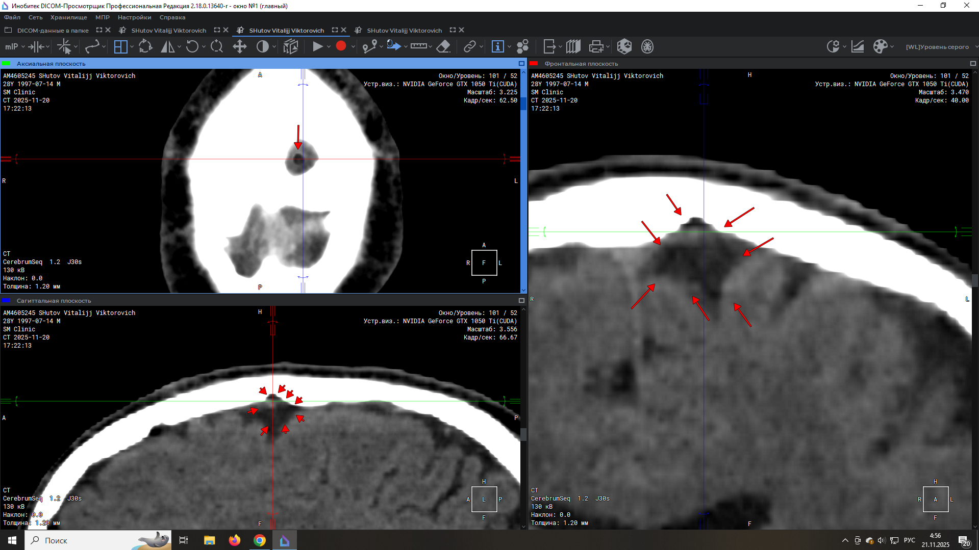 Illegal implant CT